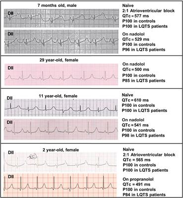 Ranolazine as an Alternative Therapy to Flecainide for SCN5A V411M Long QT Syndrome Type 3 Patients